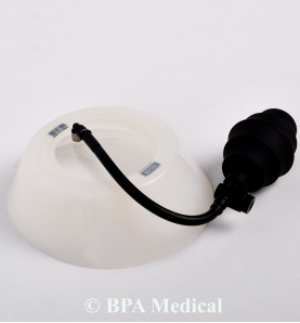 Mini Vacuum Bell 16 cm – Pediatric Pectus Excavatum Treatment Device